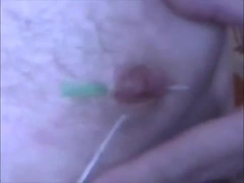 Nipple needles again