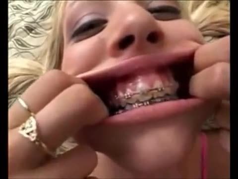 Braces braces braces compilation