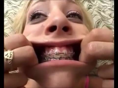 Braces braces braces compilation